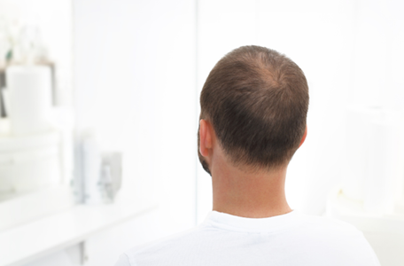 DU_CREASTIM_SILO_HAIR-LOSS_KREISRUNDER HAARAUSFALL_CONTENT_BANNER